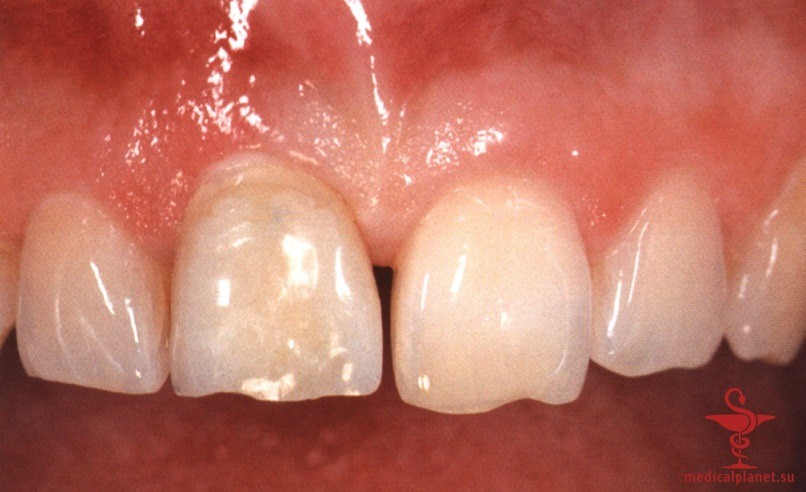 ���������������� ������ ����������� ����������� ����� � ����������� �������� ����