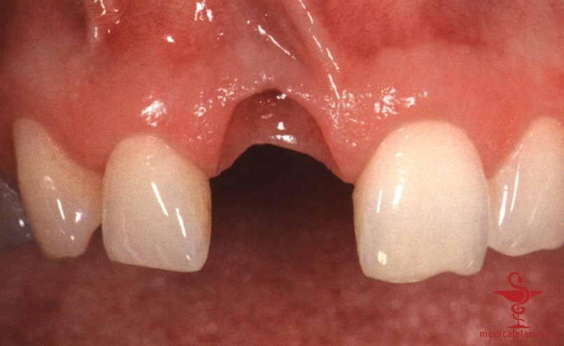 ���������������� ������ ����������� ����������� ����� � ����������� �������� ����