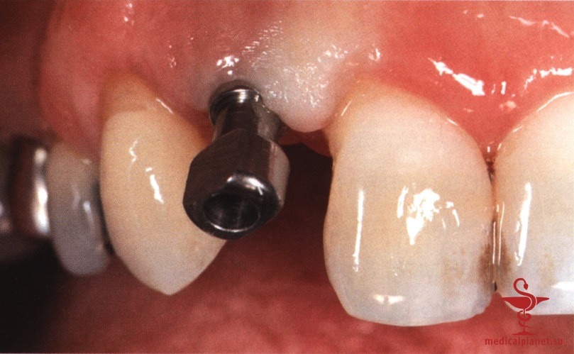 ���������������� ������ ����������� ����������� ����� � ����������� �������� ����