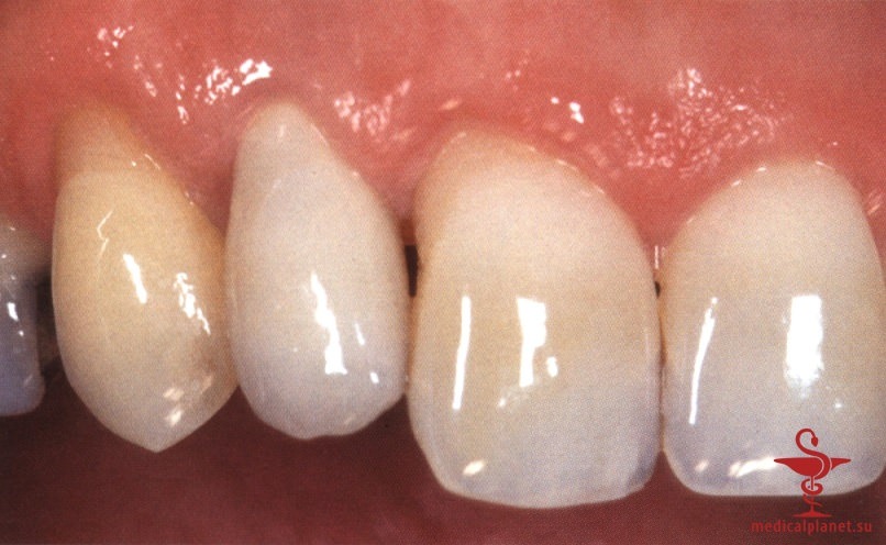 ���������������� ������ ����������� ����������� ����� � ����������� �������� ����