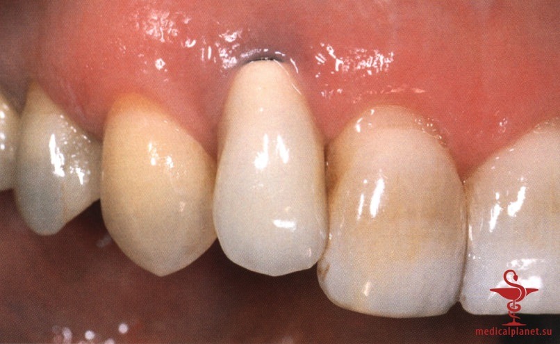 ���������������� ������ ����������� ����������� ����� � ����������� �������� ����