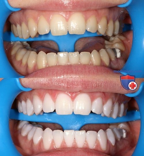 Технология отбеливания зубов Zoom 4
