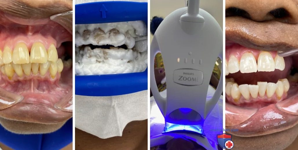 Технология отбеливания зубов Zoom 4