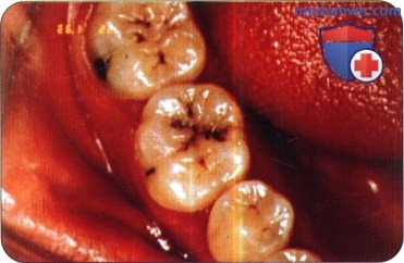 Примеры кариеса молочных и постоянных зубов у детей - фотографии