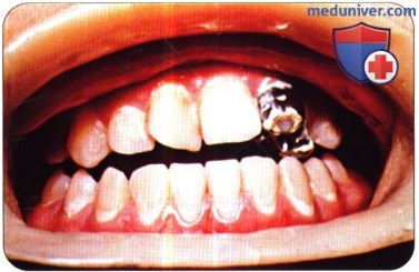 Примеры кариеса молочных и постоянных зубов у детей - фотографии