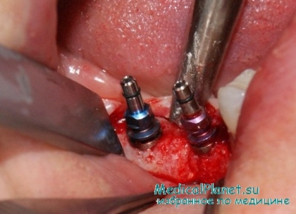 проблемы после имплантации зубов
