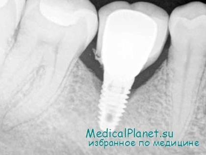 Восстановление зуба имплантацией