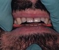 Оценка высоты окклюзии в стоматологии