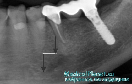 внутрикостное протезирование зубов