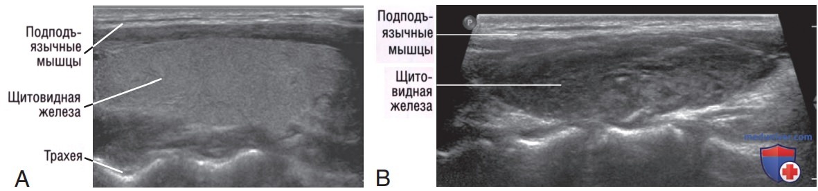 УЗИ щитовидной железы у постели больного (на месте, point-of-care)