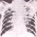 туберкулез