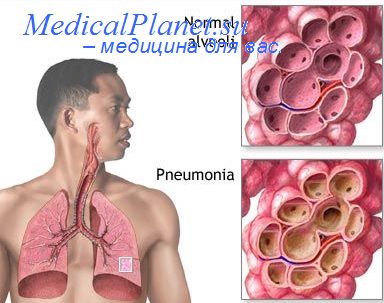 пневмония и плазмаферез