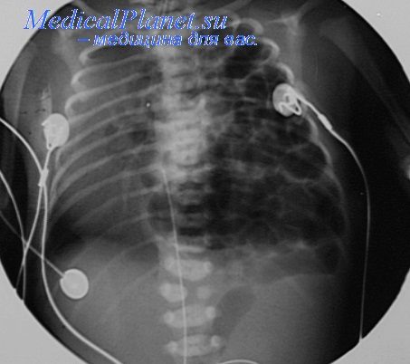 Рентгенограмма при левосторонней диафрагмальной грыже у ребенка