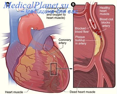 диафрагмопластика сердца
