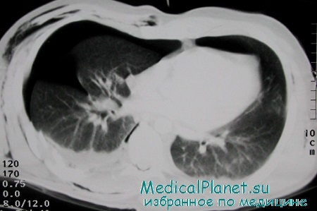 Компьютерная томография пневмоторакса справа с подкожной эмфиземой