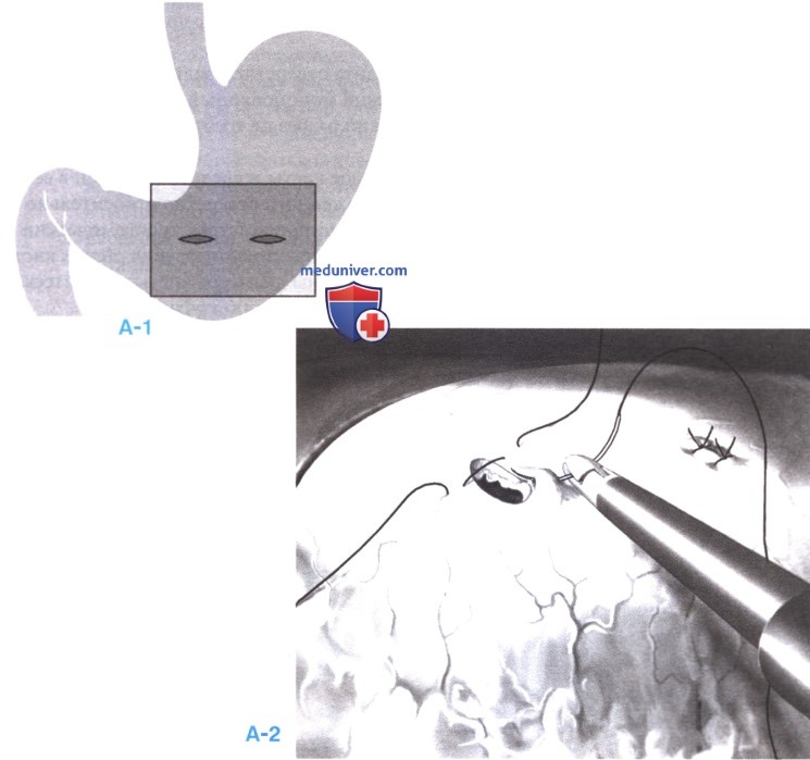 Лапароскопическая цистогастростомия при кисте поджелудочной железы