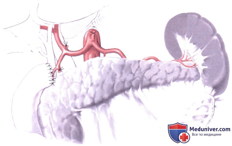 Операция при раке нижнего отдела пищевода и кардиального отдела желудка через левый торакоабдоминальный доступ