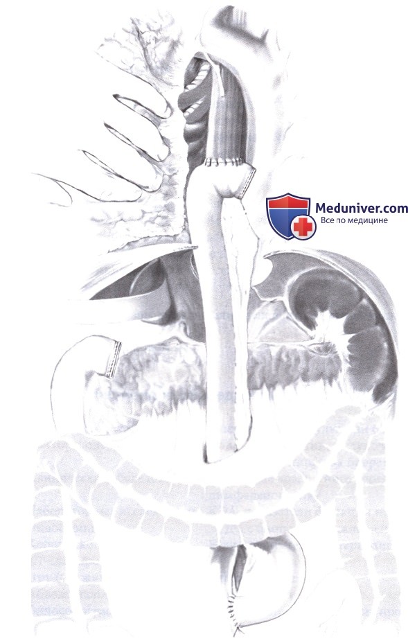 Операция при раке нижнего отдела пищевода и кардиального отдела желудка через левый торакоабдоминальный доступ