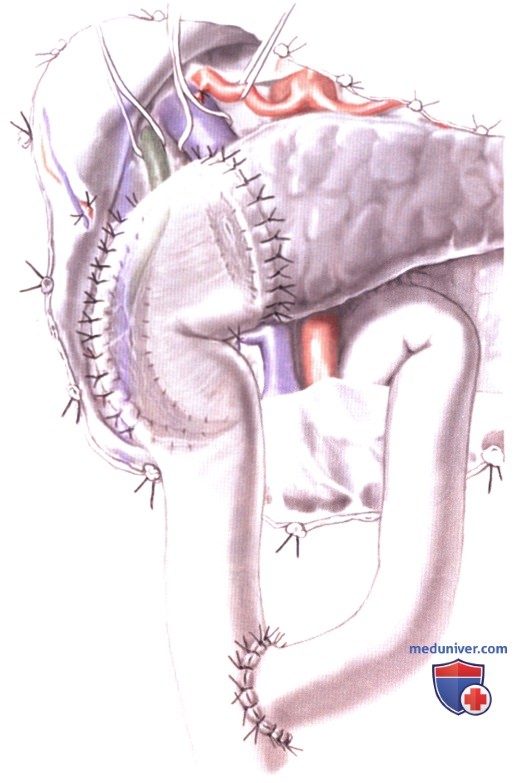 Операция Бегера (неанатомическая резекция головки поджелудочной железы с сохранением двенадцатиперстной кишки)