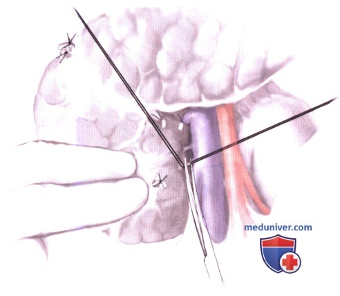 Операция Фрея (местная резекция головки поджелудочной железы с продольной панкреатикоеюностомией)