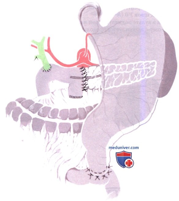 Проксимальная резекция поджелудочной железы при хроническом панкреатите