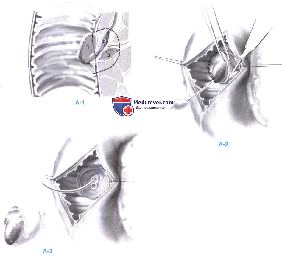 Трансдуоденальная резекция периампулярных ворсинчатых новообразований поджелудочной железы