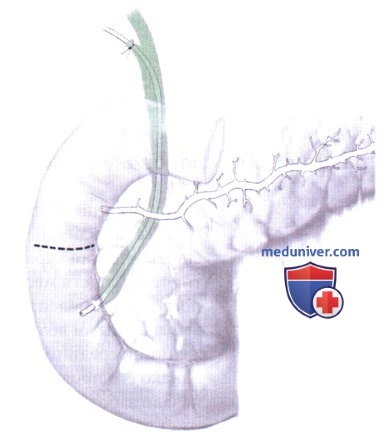 Сфинктеропластика при разделенном протоке поджелудочной железы